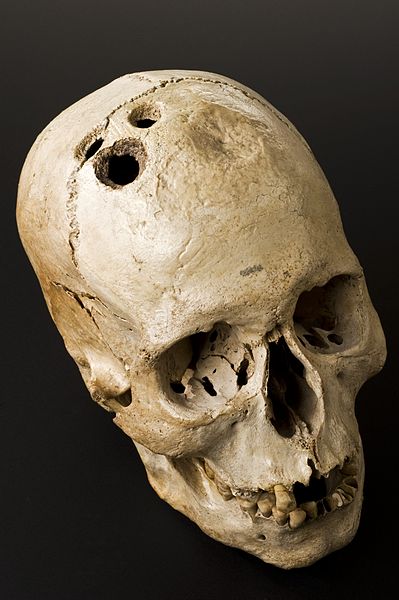 trepanation skull